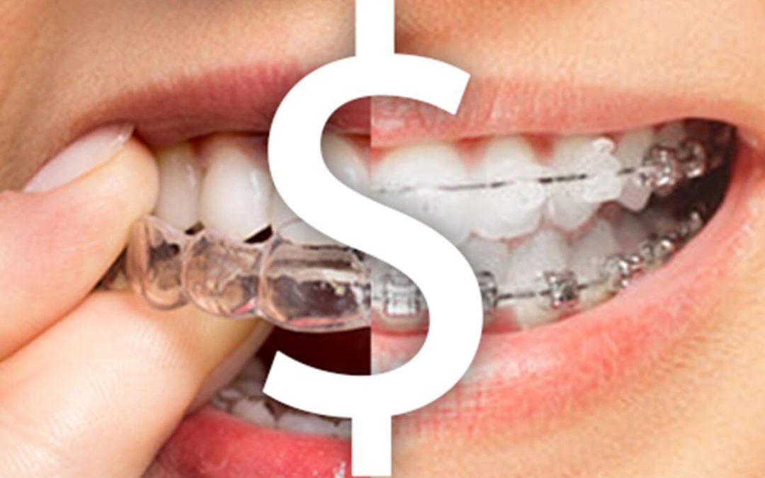 Cost of Invisalign in Singapore: All you need to know (2019)
