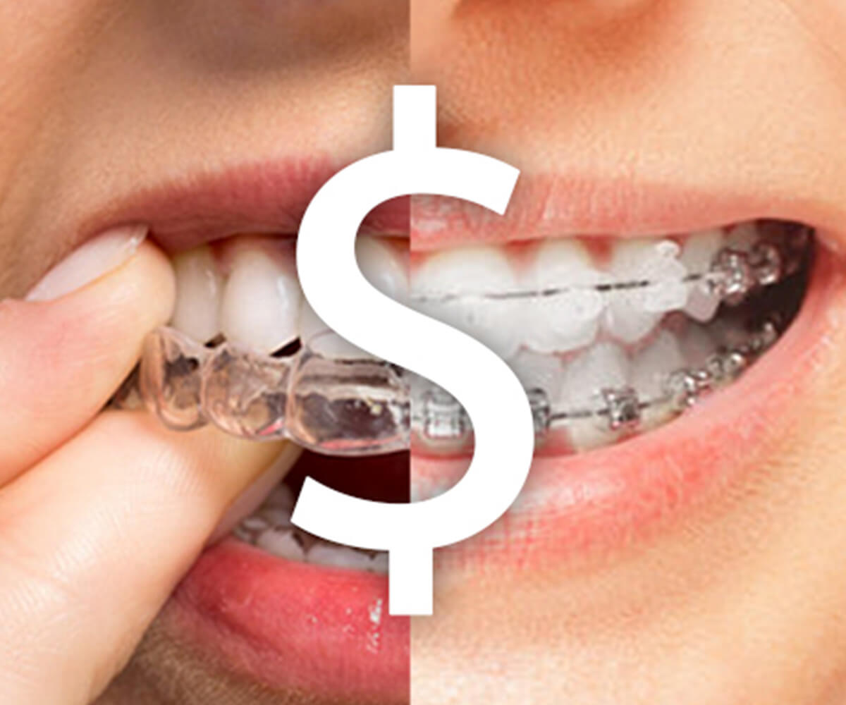 Cost of Invisalign in Singapore: All you need to know (2019)