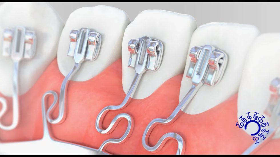 Lingual Braces And Brava By Brius The Orthodontic Clinic